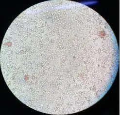 凝聚胺法交叉配血次侧凝集怎么破?有图有真相!