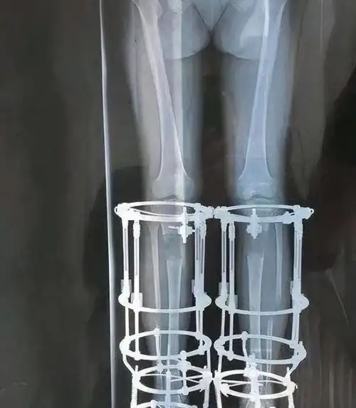 2厘米,如今与后遗症为伴|手术|截肢|小杰|医生|世界关节炎日_网易订阅