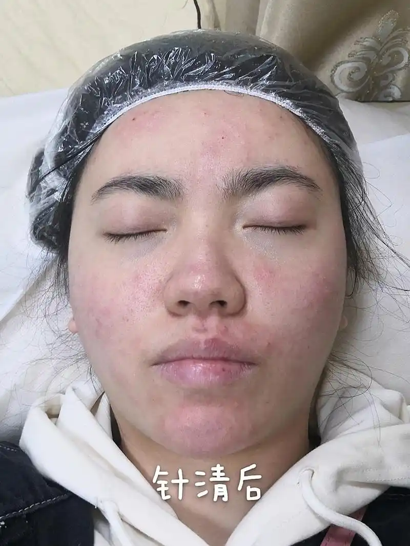 针清红光果酸换肤7天效果反馈