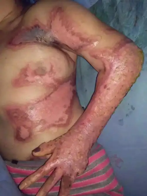 平安医院烧伤科主治医师提示,烧烫伤如洪水猛兽,现场救护尤其重要!