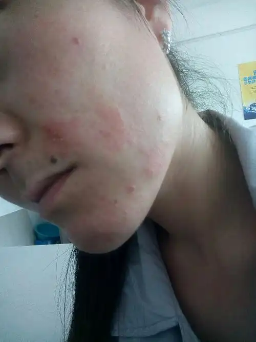 急求助脸上一块块的皮肤起皮并且有越来越多变大的趋势