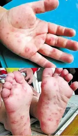 手足口病和疱疹性咽峡炎分不清?关于"疱疹性咽峡炎"大家都了解多少?