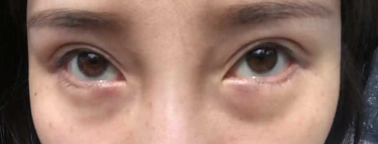 我做完眼睑下至一个月了为什么眼袋还是那么肿有一样情况的姐妹吗