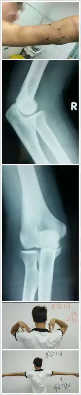 关节镜下治疗肘关节游离体