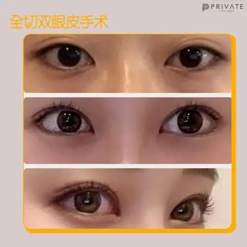 纯干货全切和埋线你真的选对了吗