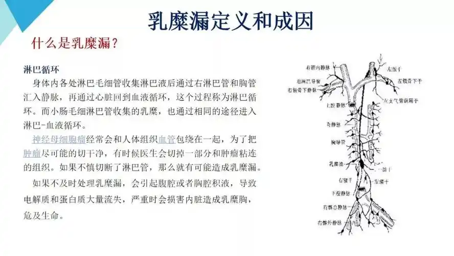 【案例】华品珍:胃癌术后乳糜漏案例分享