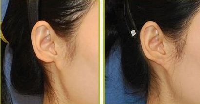 玻尿酸丰耳垂的价格主要与下面几个因素有关