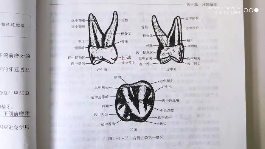 右侧上颌第一磨牙