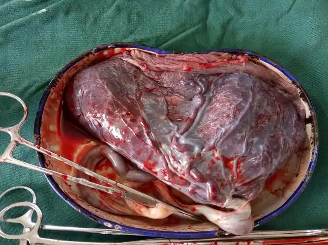 胎盘被取出来了