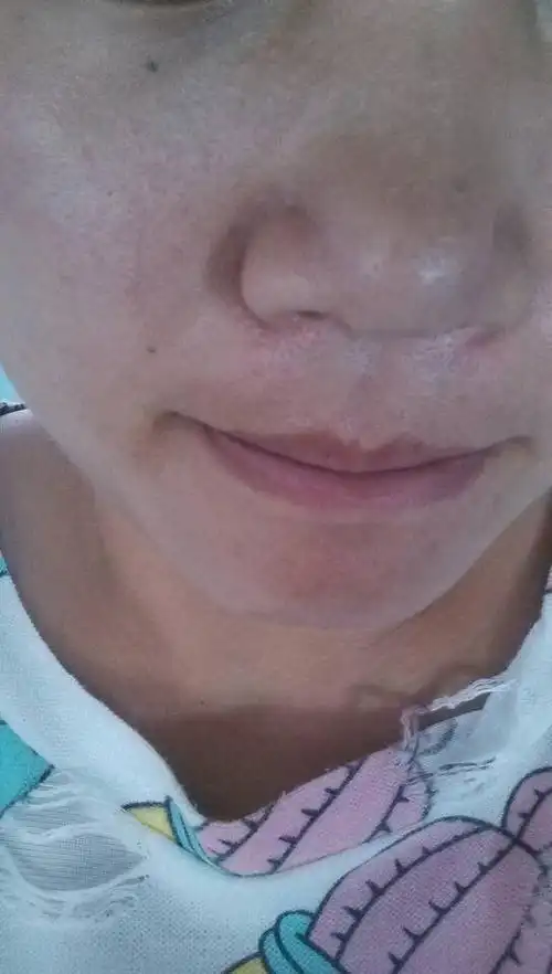 求毛孔堵塞照片