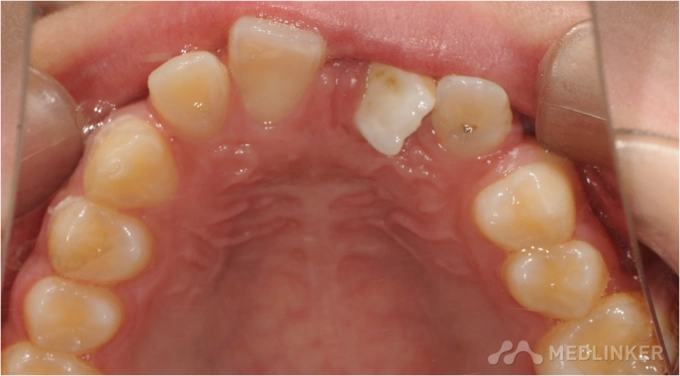 上中切牙冠根成角一例