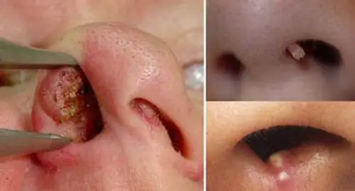 鼻窦炎症状图片 (44)