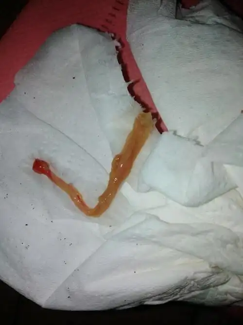 宝妈帮忙看看这是不是胎盘残留