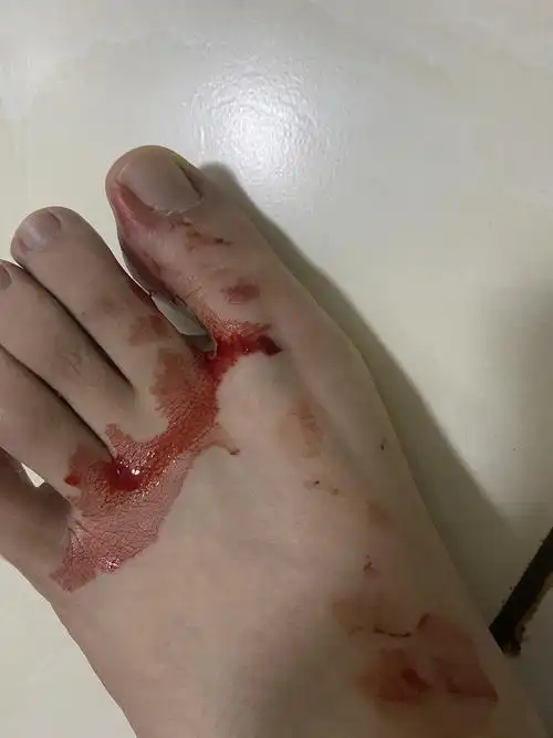 【讨论】有图慎入 半夜起床上厕所被狗咬了脚