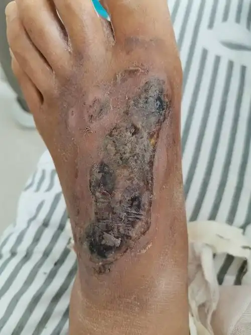传统中医药治疗皮肤坏死一例
