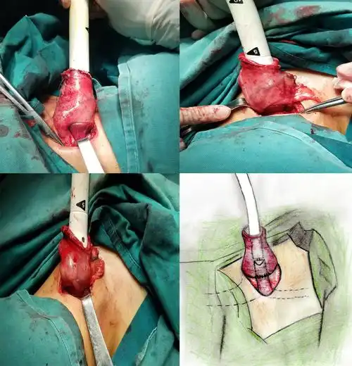 独创新式吻合方法,解决食管癌手术大问题