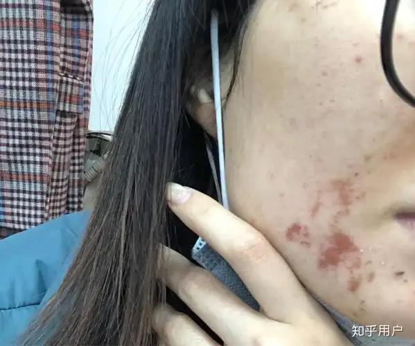 呜呜呜呜有没有做过果酸换肤的姐妹第一次做完果酸换肤第二天就结痂