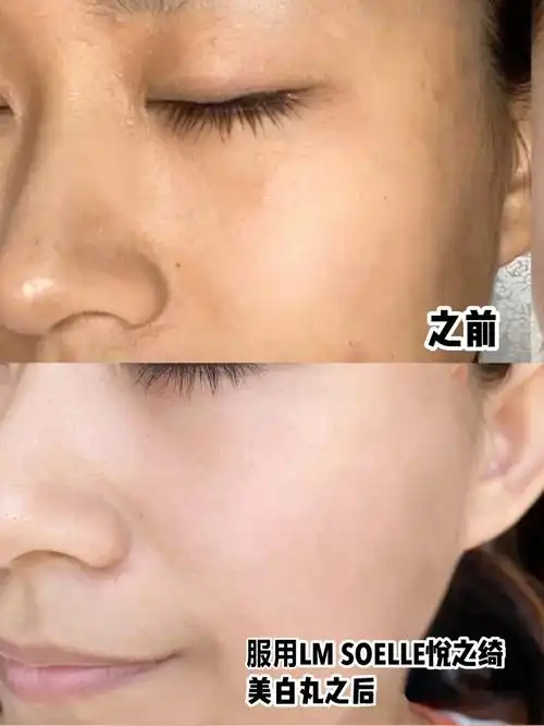 前后对比容颜应是你赋予生活的模样,lm soelle悦之绮护肤愿你成就自信