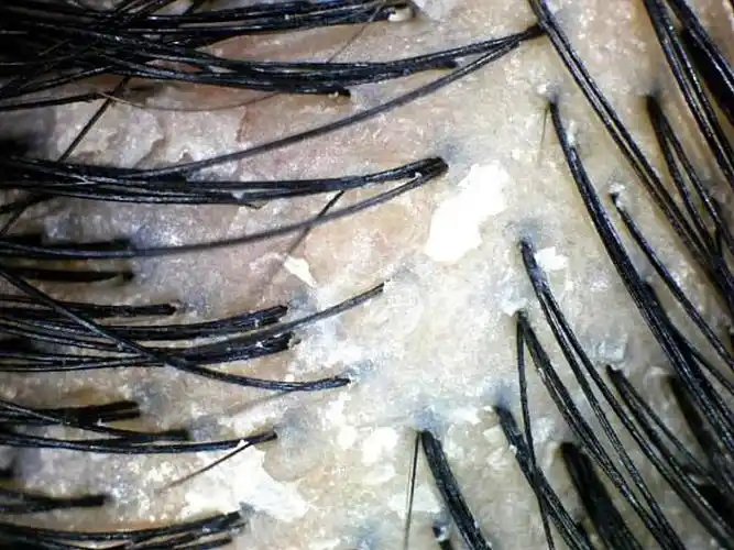 图一二为干性头皮治疗前后