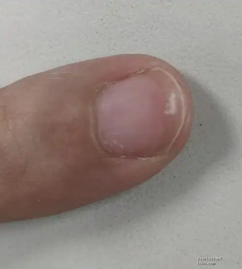 指甲有白色的是不是肚里有虫