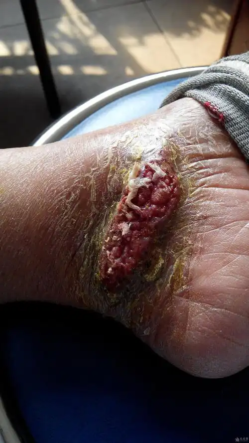 高手进来看看啊,这个皮肤病怎么治疗,内附图片!