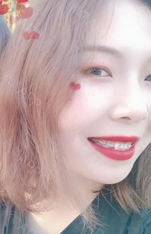 21岁口腔空间小虎牙牙齿拥挤一周前拔了两个4是真的疼一个小时前刚带