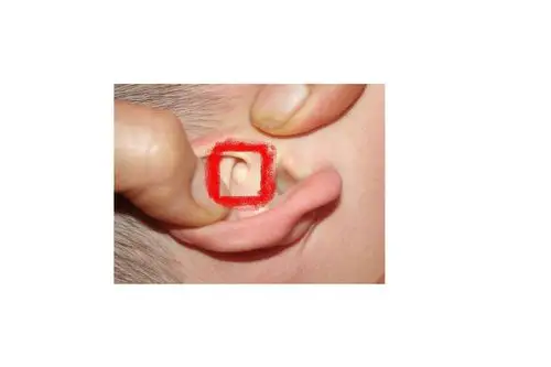 小女孩2岁,右耳朵耳廓长了个包(约0.5cm大小