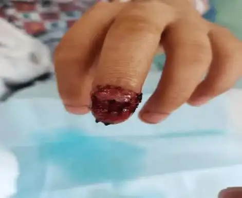 注意!家长不留意,孩子差点被截指