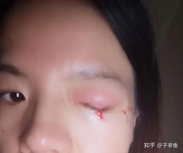 麦粒肿,再别来了,好吗