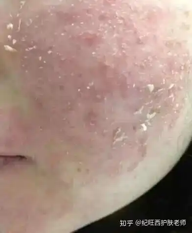 激素脸干燥起皮是好转还是加重了看完这个你就整明白了