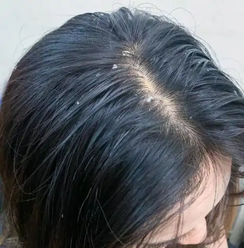 判断自己是哪种发质,油性发质细软塌,混合性发质油腻还有头皮屑