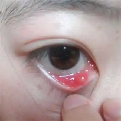 让孩子长眼疖子的食物 千万不要吃