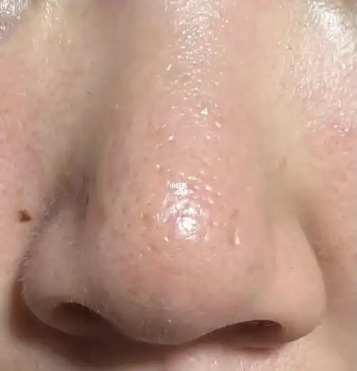 鼻子毛孔粗大卡粉到怀疑人生