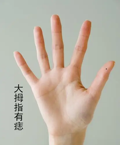 手上长痣是好是坏,都有什么寓意