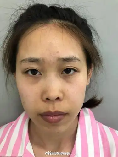 济南做鼻子案例:济南玻尿酸垫鼻子做鼻子5. 来自变美娜些事儿 - 微博