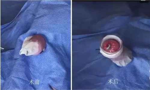 昆山虹桥医院 小儿微创包皮环切术 ·门诊手术,随做随走: 昆山虹桥