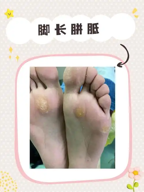 有胼胝的姐妹来看!(上岸篇)