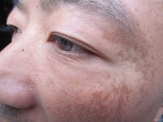皮肤色素斑三年