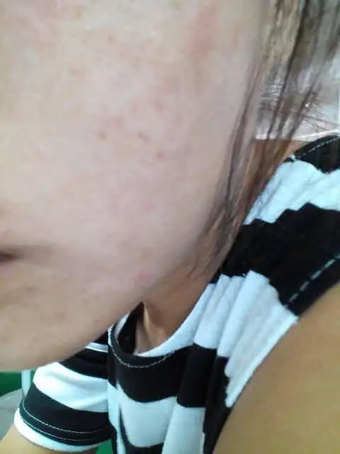 医师来自沧州市新华区妇幼医院 答: 你好,应该是化妆品过敏,现在皮肤