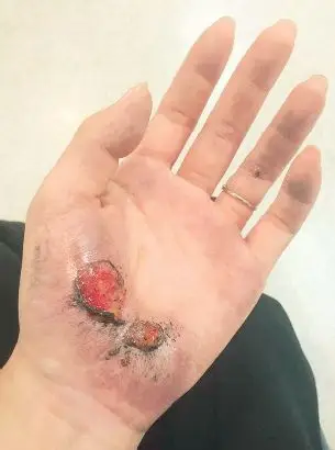 刘女士的手因为追歹徒受伤.