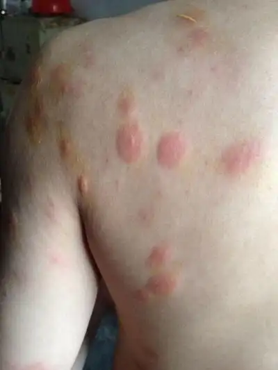 皮肤湿毒症状图片 (48)_有来医生