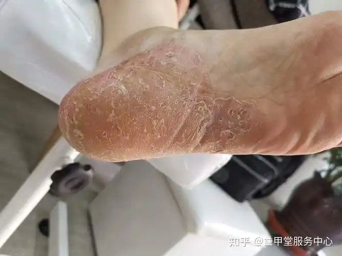 得了脚气别怕试试这个办法