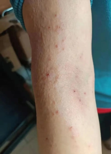 一个多年久治不愈的手脚干性湿疹