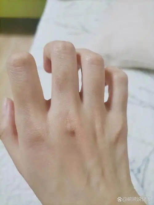 拔毛癖到底该怎么办!