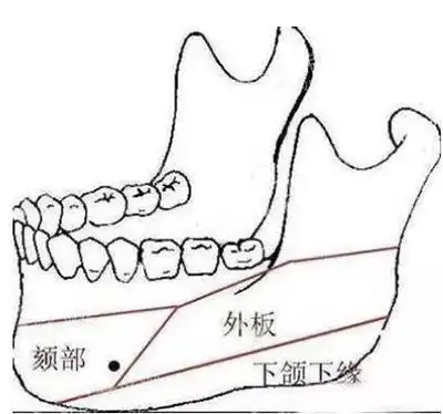 长曲线下颌骨手术必须做外板吗磨外板和劈外板哪个好