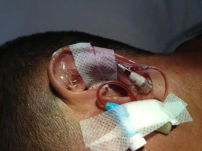 耳廓假性囊肿-新思维新方法你造吗