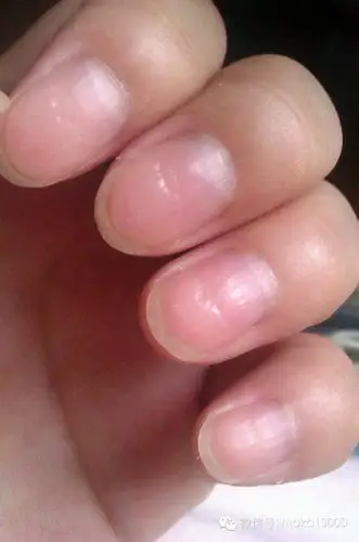 指甲上有一道道棱线是身体有问题,你正常吗