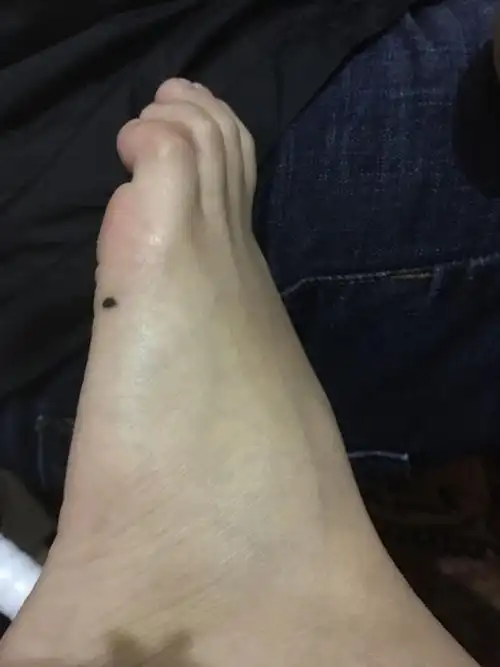 我左脚上这颗痣是好还是坏