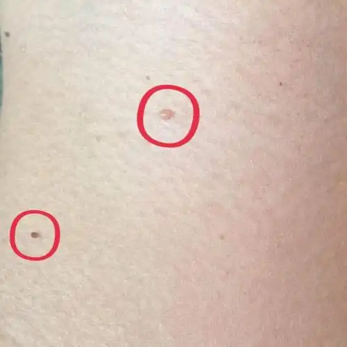 终于知道了我脖子上的小肉瘤是什么情况?