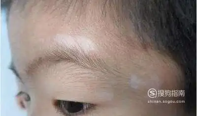 01白癜风早期的白斑颜色多数是浅白色,淡白色,随着病情的发展,会慢慢